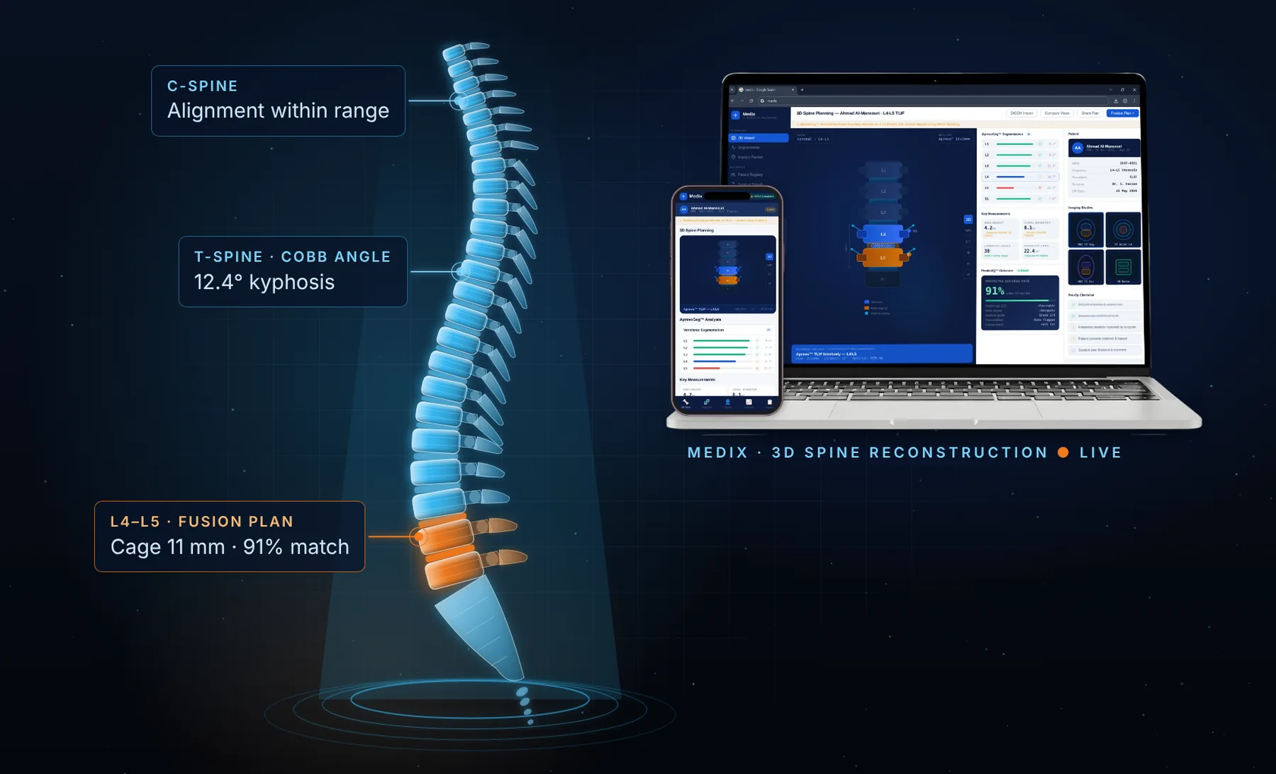 Medix 3D spine reconstruction with surgical planning on laptop and phone